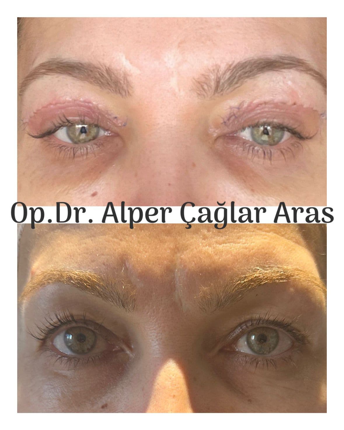 Case 03 · upper blepharoplasty