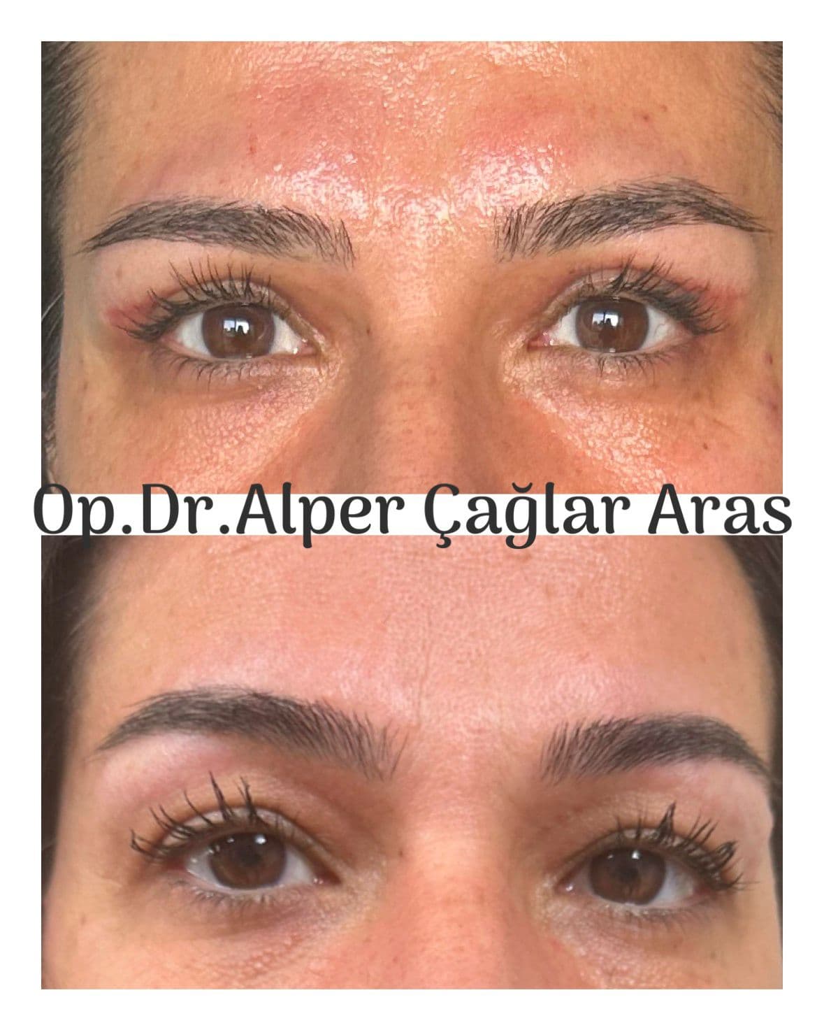 Case 01 · upper blepharoplasty
