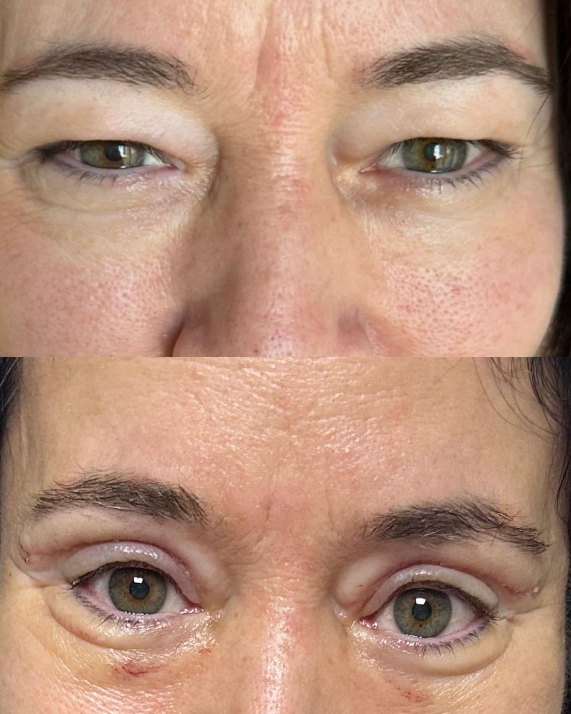 Case 02 · upper blepharoplasty